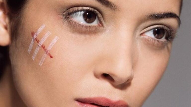 Tırnak izleri nasıl kaldırılır? Yüzdeki ve ciltteki tırnak izleri nasıl kaldırılır?